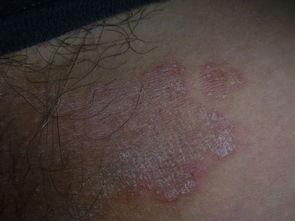 腿红肿图片,成因与应对策略