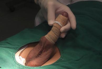 阴茎坏图片,图解常见病症与预防措施